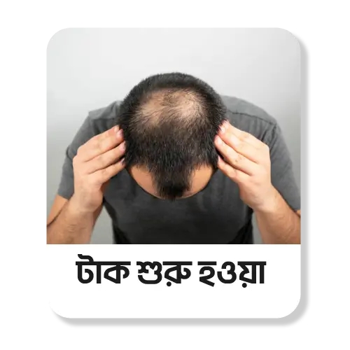 টাক শুরু হওয়া